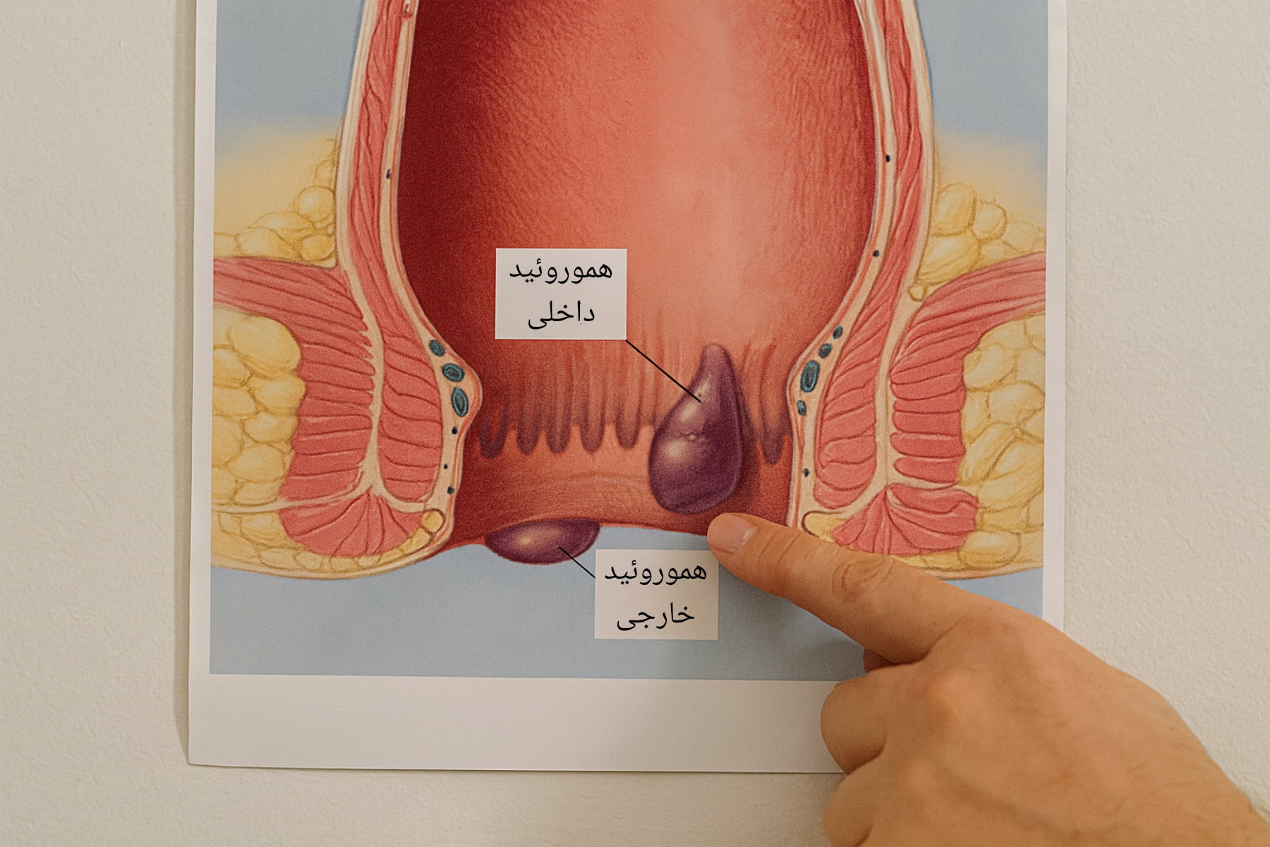 عکس بواسیر در کودکان هایلایت زرد