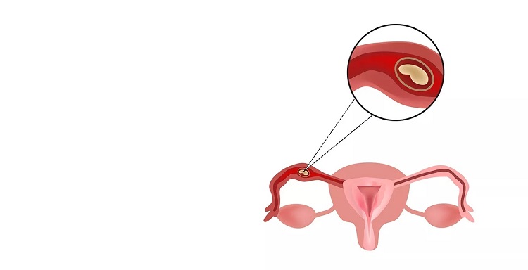 Ectopic-Pregnancy-Desktop1