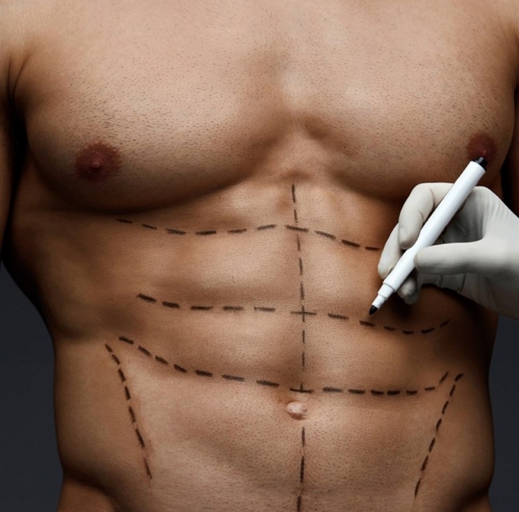 high-definition-liposuction-with-regional-anesthesia