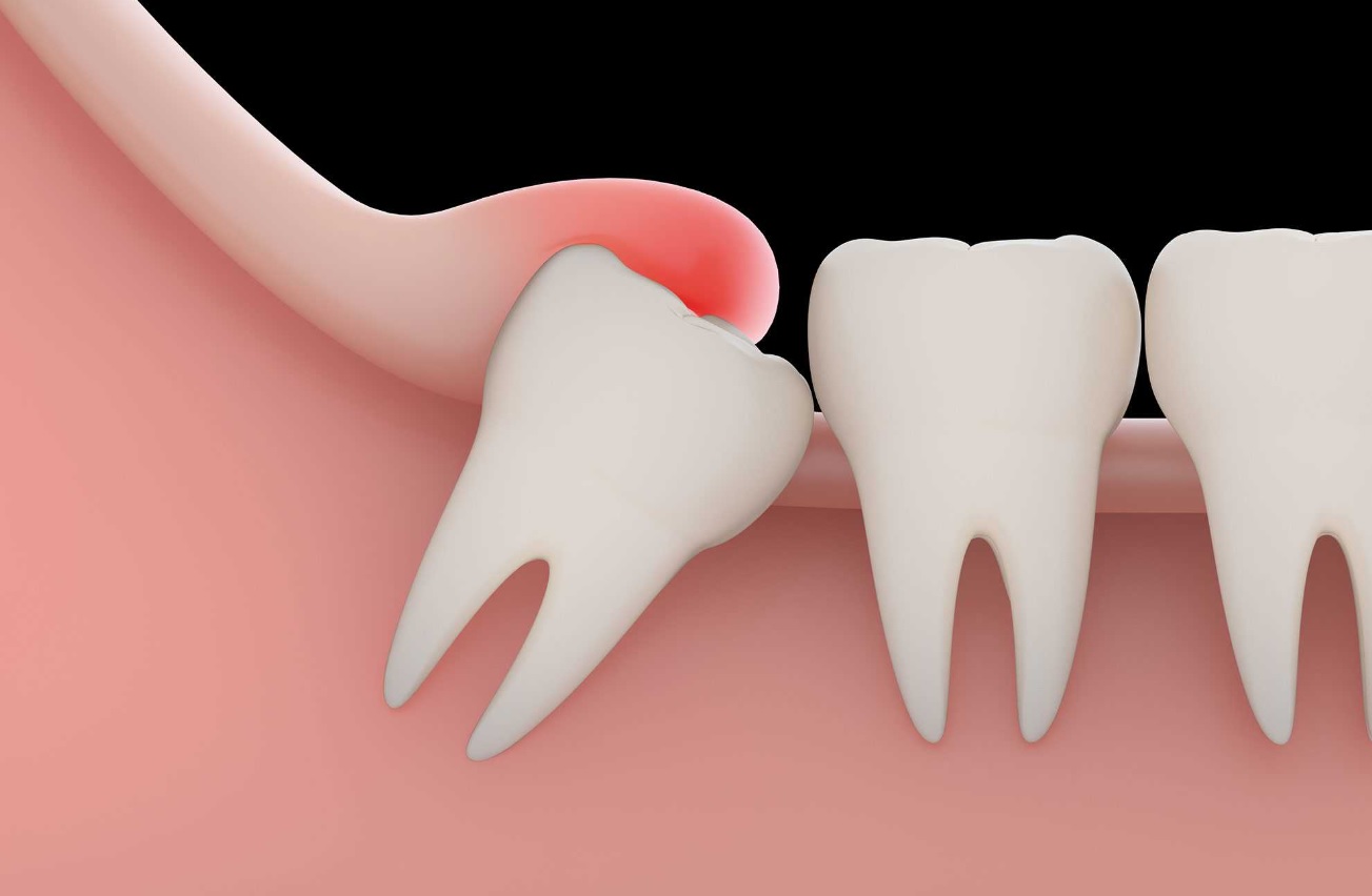 دندان عقل نیمه نهفته چه عوارضی دارد؟