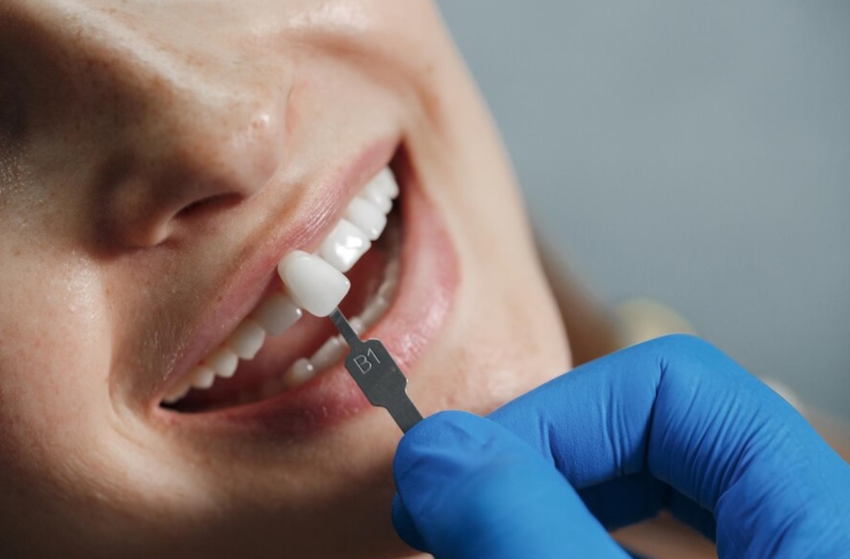 لمینت دندان فوری، مزایا، عوارض و کاربرد این روش