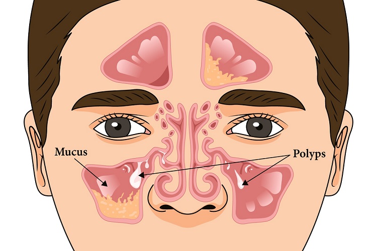 Graphical-representation-of-chronic-sinusitis1