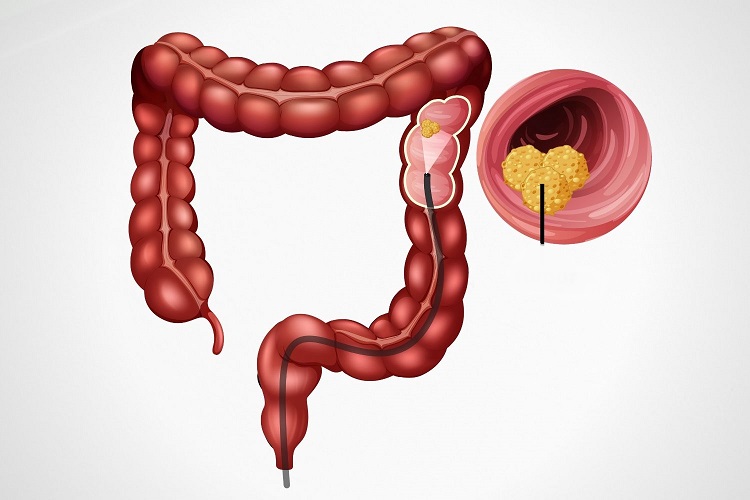 Colonoscopy-NuLife-Hospital