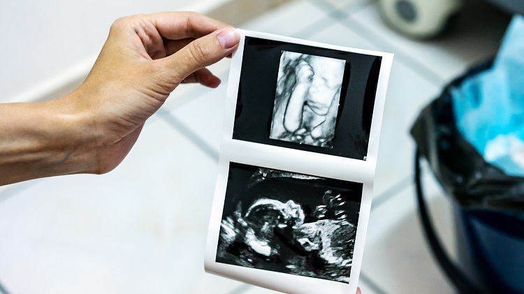 3D-and-4D-Ultrasounds-Are-They-Worth-the-Risk-pregnancy-post-by-Mama-Natural