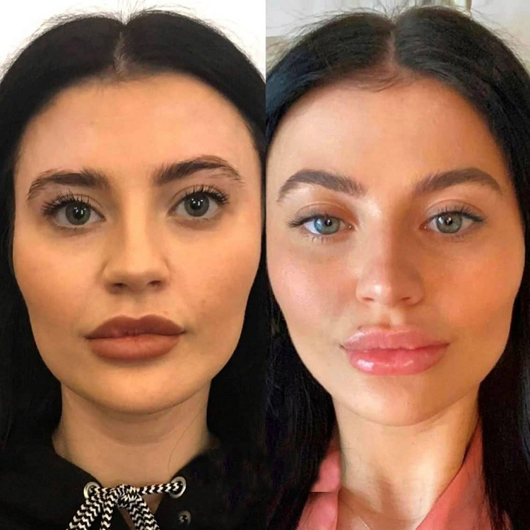 بهبودی-پس-از-لیفت-ابرو-ها-با-نخmin