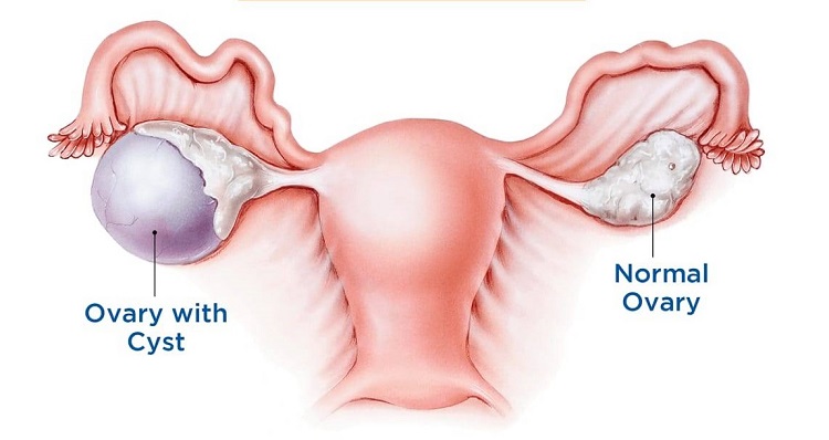 تاثیر کیست‌های تخمدان بر سلامت روانی زنان