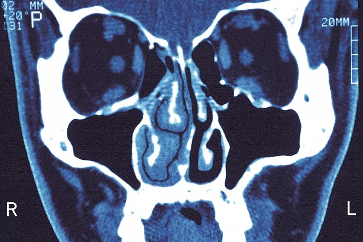 chronic-sinusitis-16-scaled1