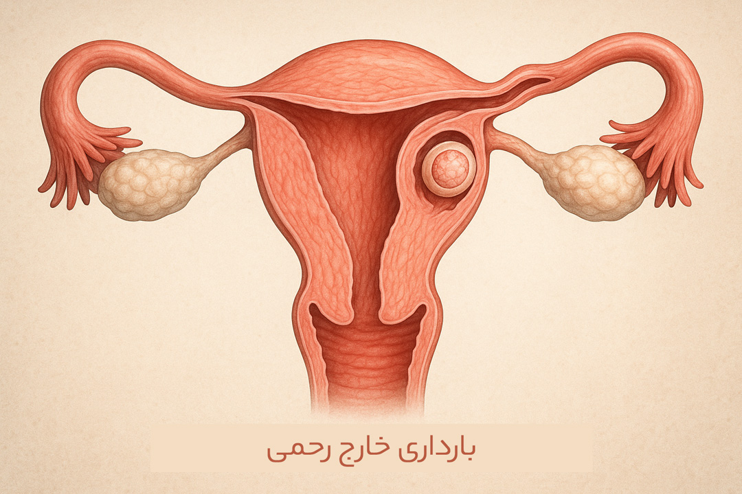 بارداری-خارج-رحمی