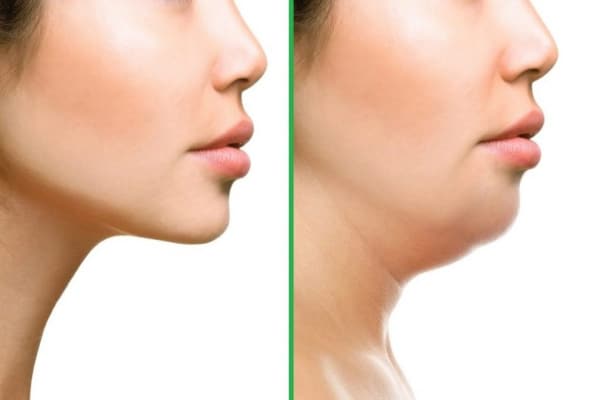اندولیفت غبغب چیست و چگونه انجام می شود؟