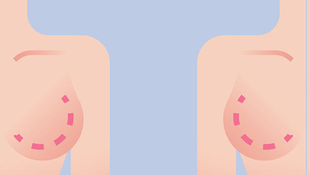 mammoplasty