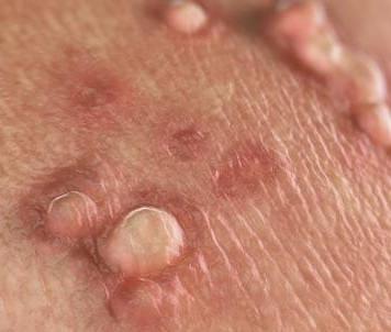 خیلی رُک و صریح؛ راه‌حل قطعی عدم ابتلا به HPV پیدا شد