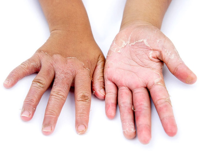 علت پوسته شدن کف دست: آیا ربطی به قاعدگی دارد؟