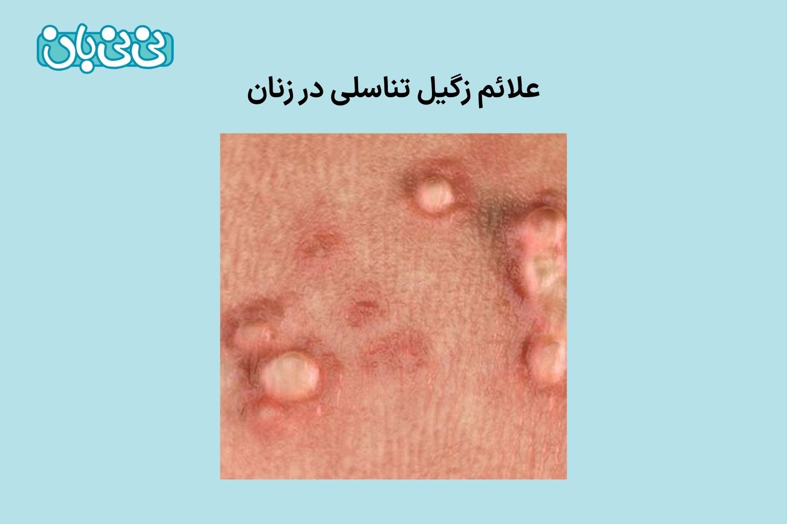 علائم زگیل تناسلی در زنان عکس (1)