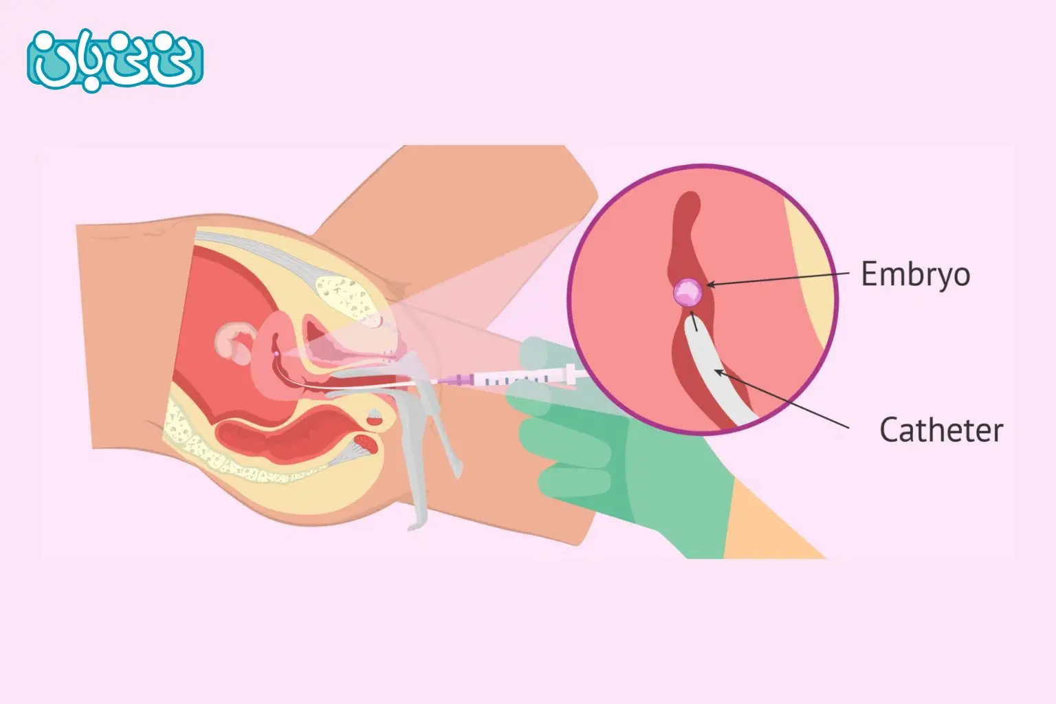 انتقال جنین چیست