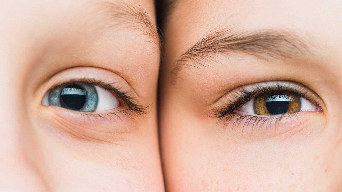 عمل تغییر رنگ چشم چگونه است؟ خطر دارد؟