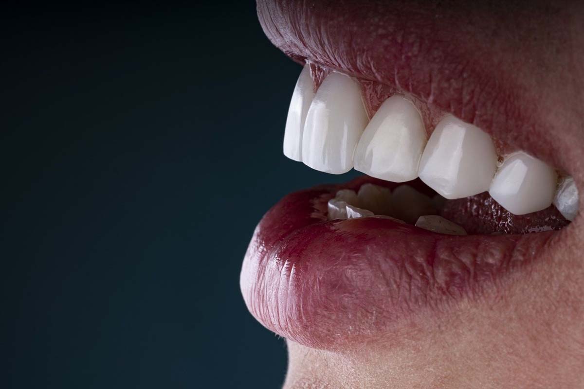 Dental laminate