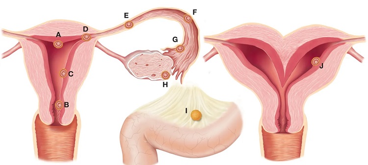 implantation-sites-ovum-human-reproductive-tract-Implantation1