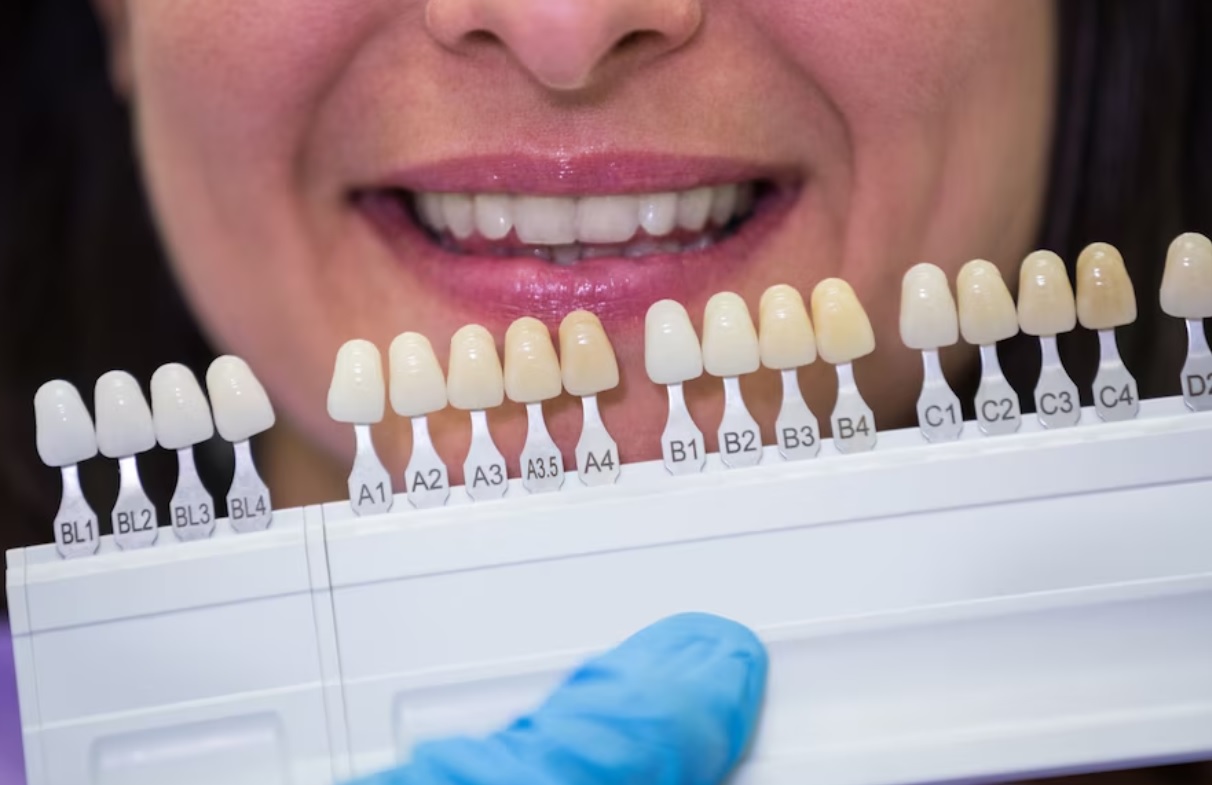 لمینت دندان فوری، مزایا، عوارض و کاربرد این روش