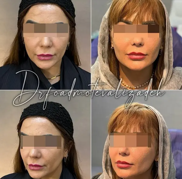 نمونه+جوانساز+نسل+4+دکتر+فواد+متولی+زاده (1)