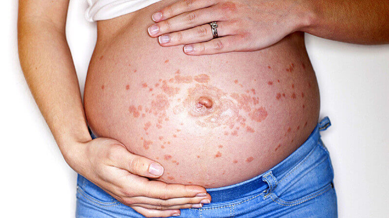  کلستاز و ختم بارداری