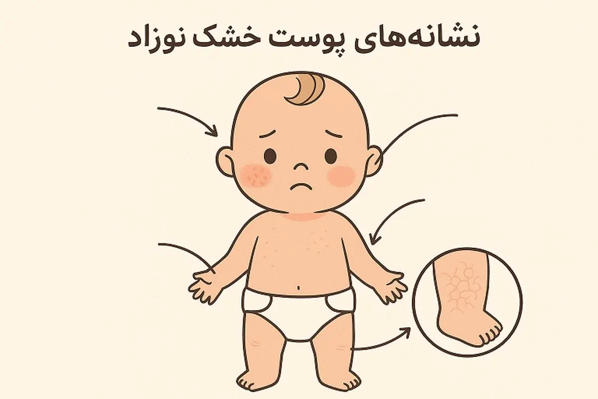 خشکی پوست نوزاد | ۶ علت شایع و راهکارهای درمان آن