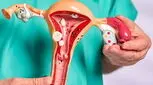 نمونه‌برداری از رحم: چه زمانی لازم است و چگونه انجام می‌شود؟