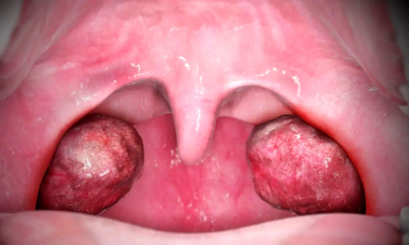 چرا لوزه را برداریم؟ چرا لوزه را برنداریم؟!