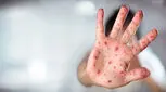 آیا این بیماری مسری به ایران بازگشته است؟!
