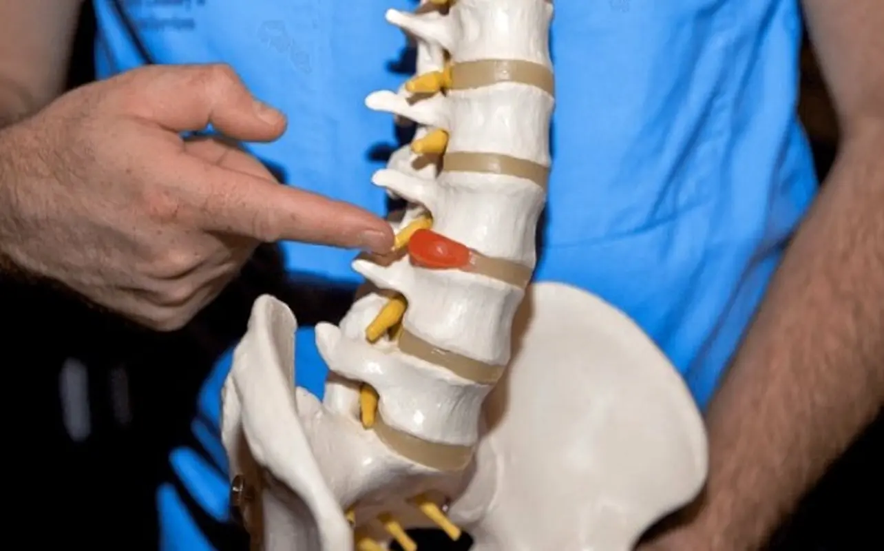 درمان جدید بیرون‌زدگی دیسک کمر در ایران کشف شد!