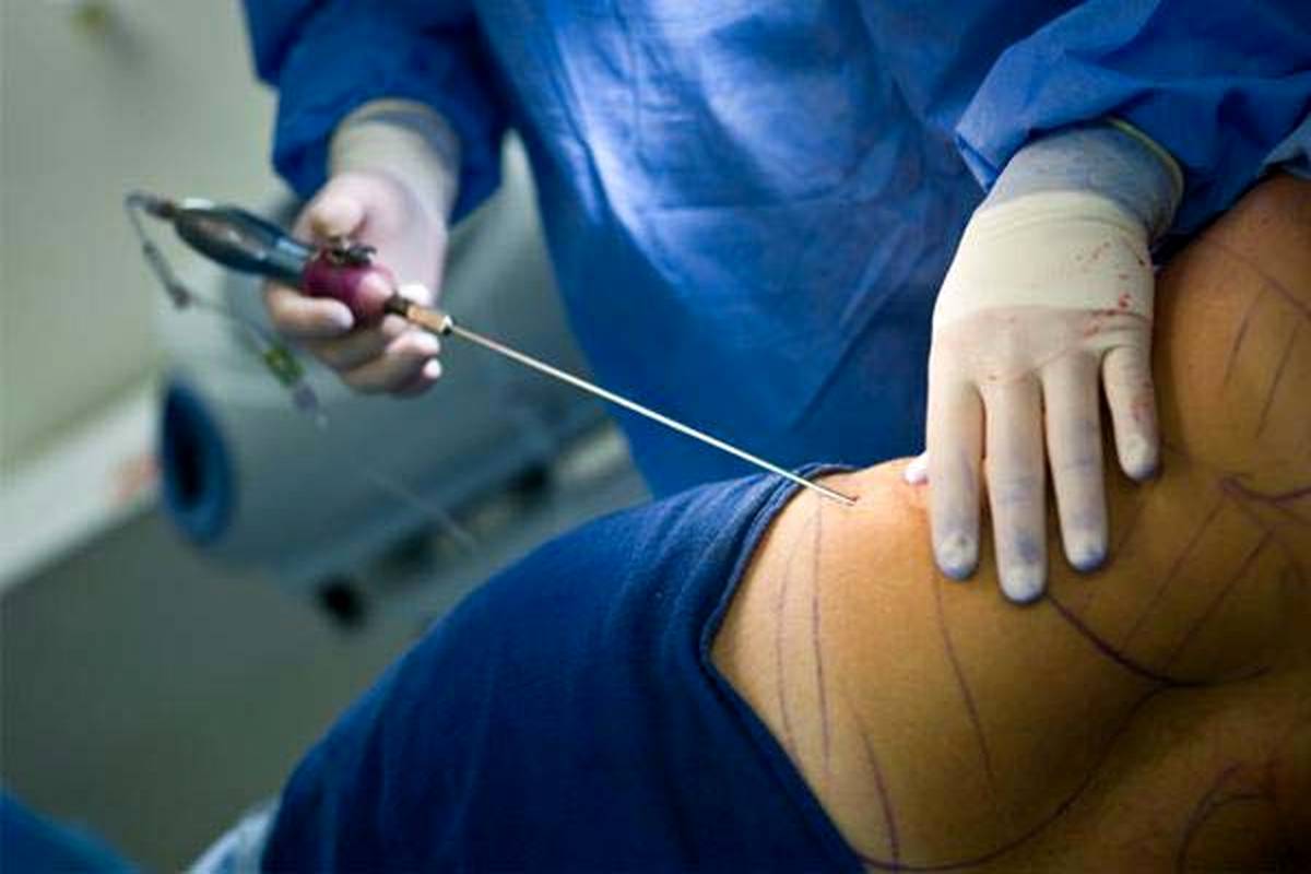 عمل اسلیو معده چیست؟ فواید، عوارض و مراقبتهای بعد از جراحی