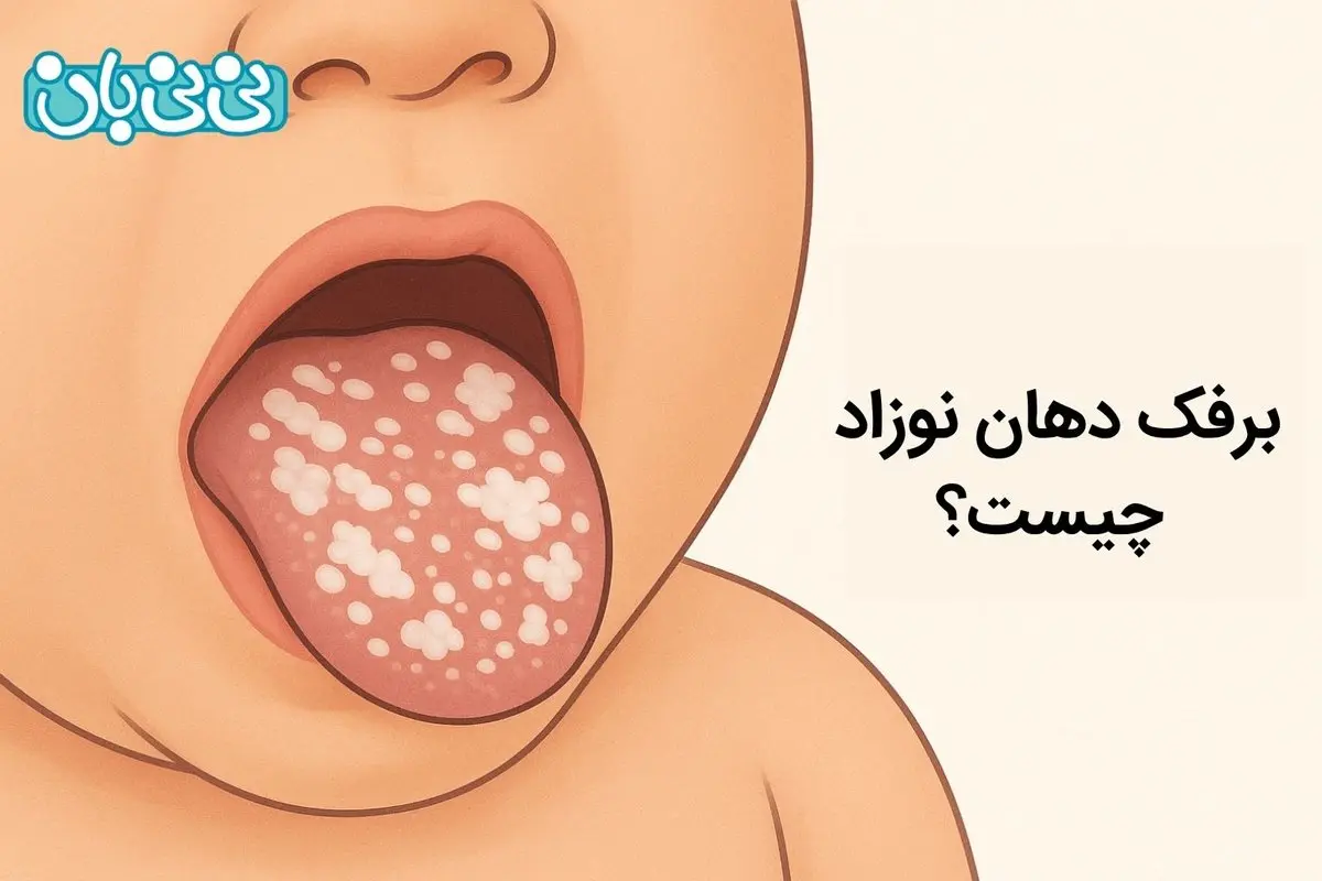 برفک دهان نوزاد چیست؟ 3 عارضه، تشخیص و درمان برفک دهان نوزاد