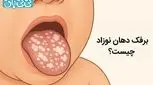 برفک دهان نوزاد چیست؟ 3 عارضه، تشخیص و درمان برفک دهان نوزاد 