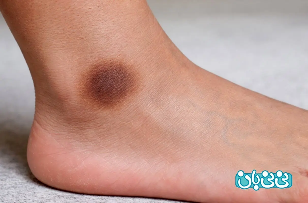 رفع تیرگی قوزک پا | بررسی علت‌ها و موثرترین روش‌های درمانی