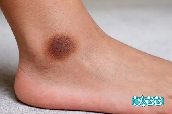 رفع تیرگی قوزک پا | بررسی علت‌ها و موثرترین روش‌های درمانی
