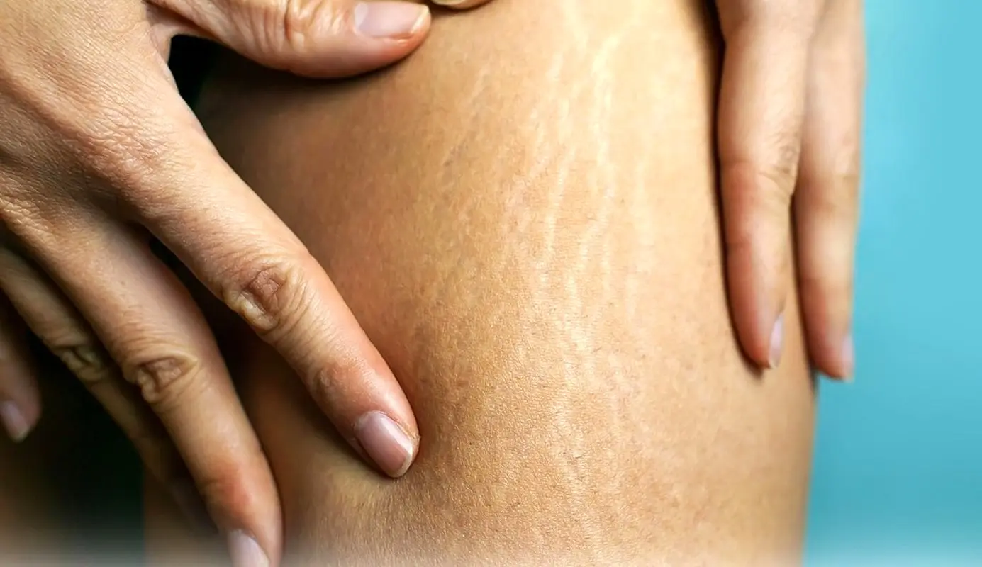 رهایی از سلولیت و چربی های مقاوم به ورزش