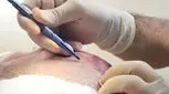 ​جدیدترین روش کاشت مو ۲۰۲۵ - کاشت رباتیک و پشت پرده تبلیغات
