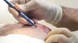 ​جدیدترین روش کاشت مو ۲۰۲۵ - کاشت رباتیک و پشت پرده تبلیغات