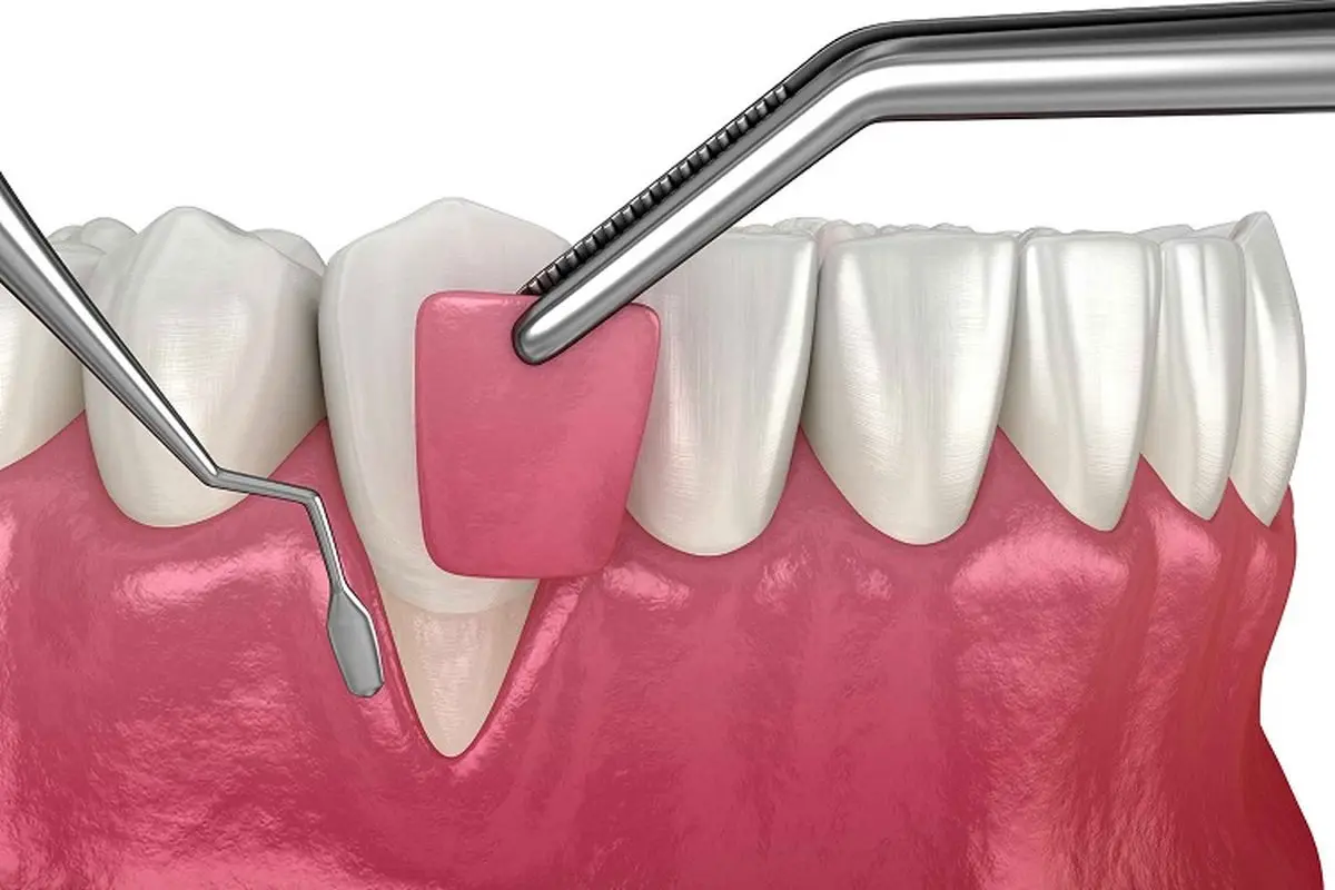 جراحی لثه چیست و چه کاربردهایی دارد؟