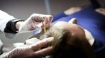 درمان ریزش مو با کربوکسی تراپی