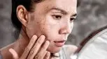 با لکه‌های پوستی بارداری چه کنیم؟/ از پیشگیری تا درمان