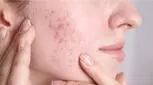 جوش و آکنه را برای همیشه و با این راهکارها از بین ببرید!