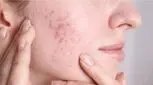 جوش و آکنه را برای همیشه و با این راهکارها از بین ببرید!