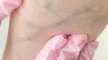 جلوگیری از واریس در بارداری، راهکار مناسب