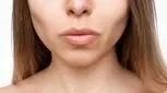 پس از «صورت اوزمپیک»، متخصصان درباره «دهان اوزمپیک» هشدار می‌‌دهند