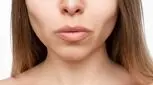 پس از «صورت اوزمپیک»، متخصصان درباره «دهان اوزمپیک» هشدار می‌‌دهند