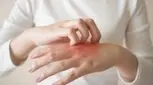 راه‌های پیشگیری از اگزمای پوست را بشناسید 
