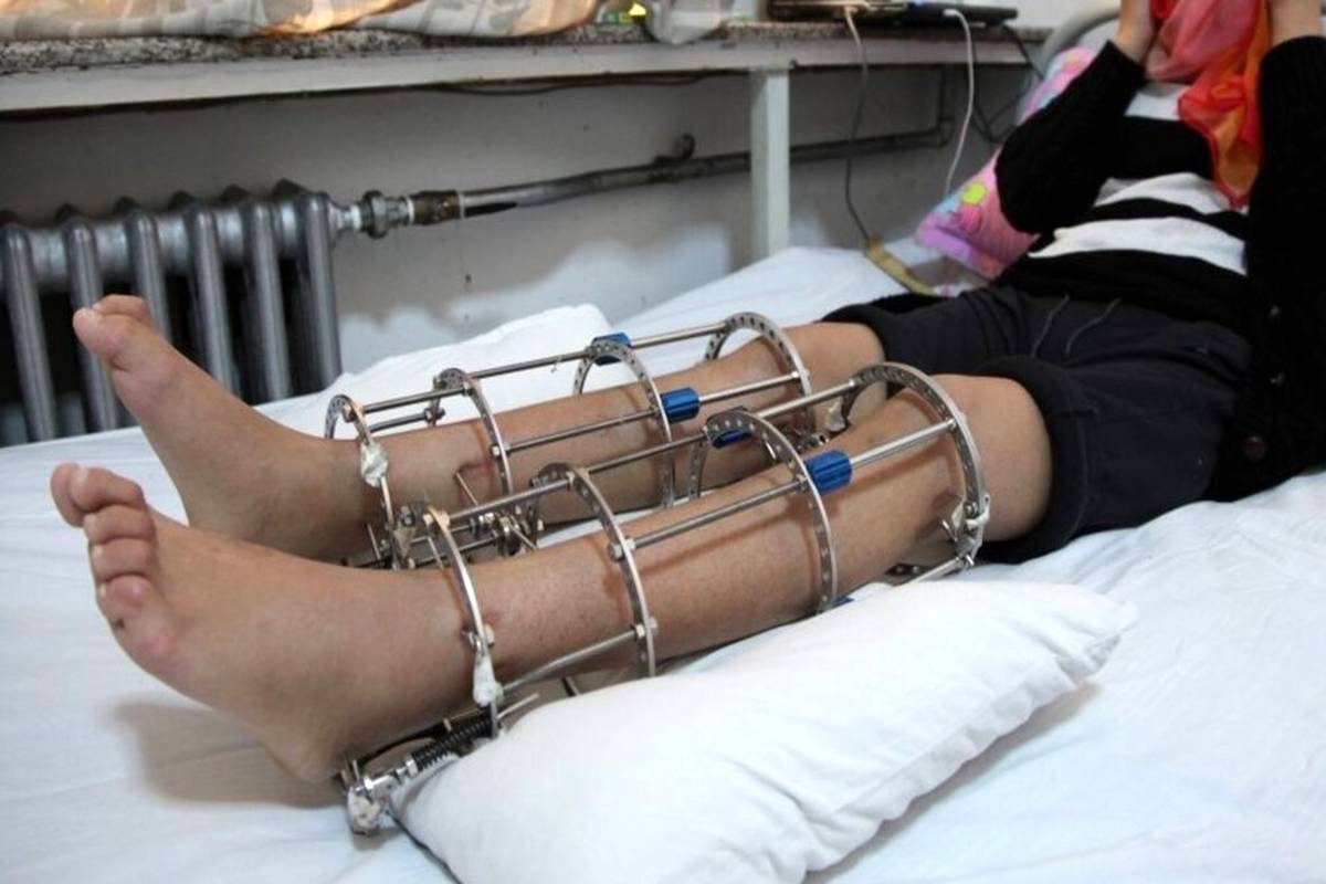شما هم می‌خواهید قد بلندی داشته باشید؟/ معجزه قرن یا شکنجه قرن؟!

