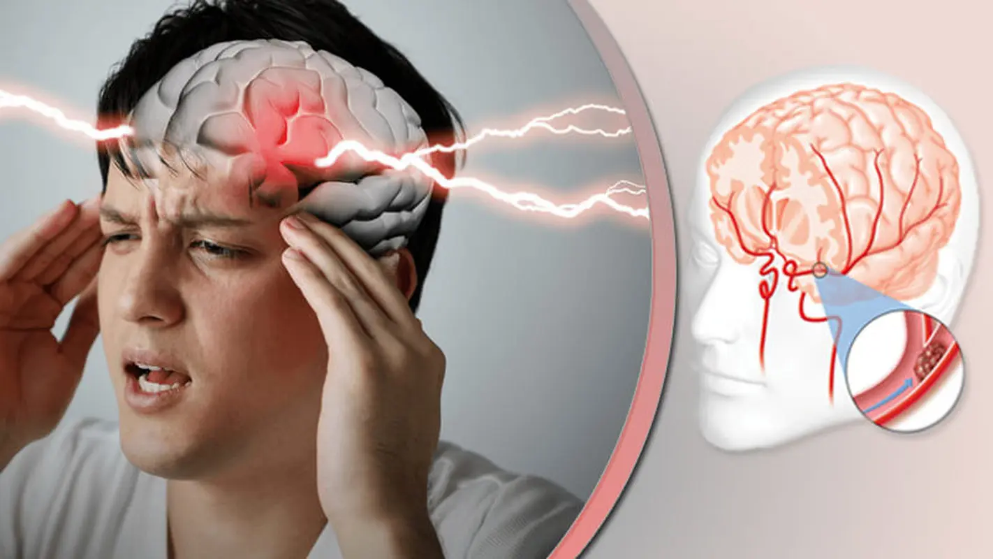 اگر سردرد شدید دارید در معرض سکته مغزی هستید!