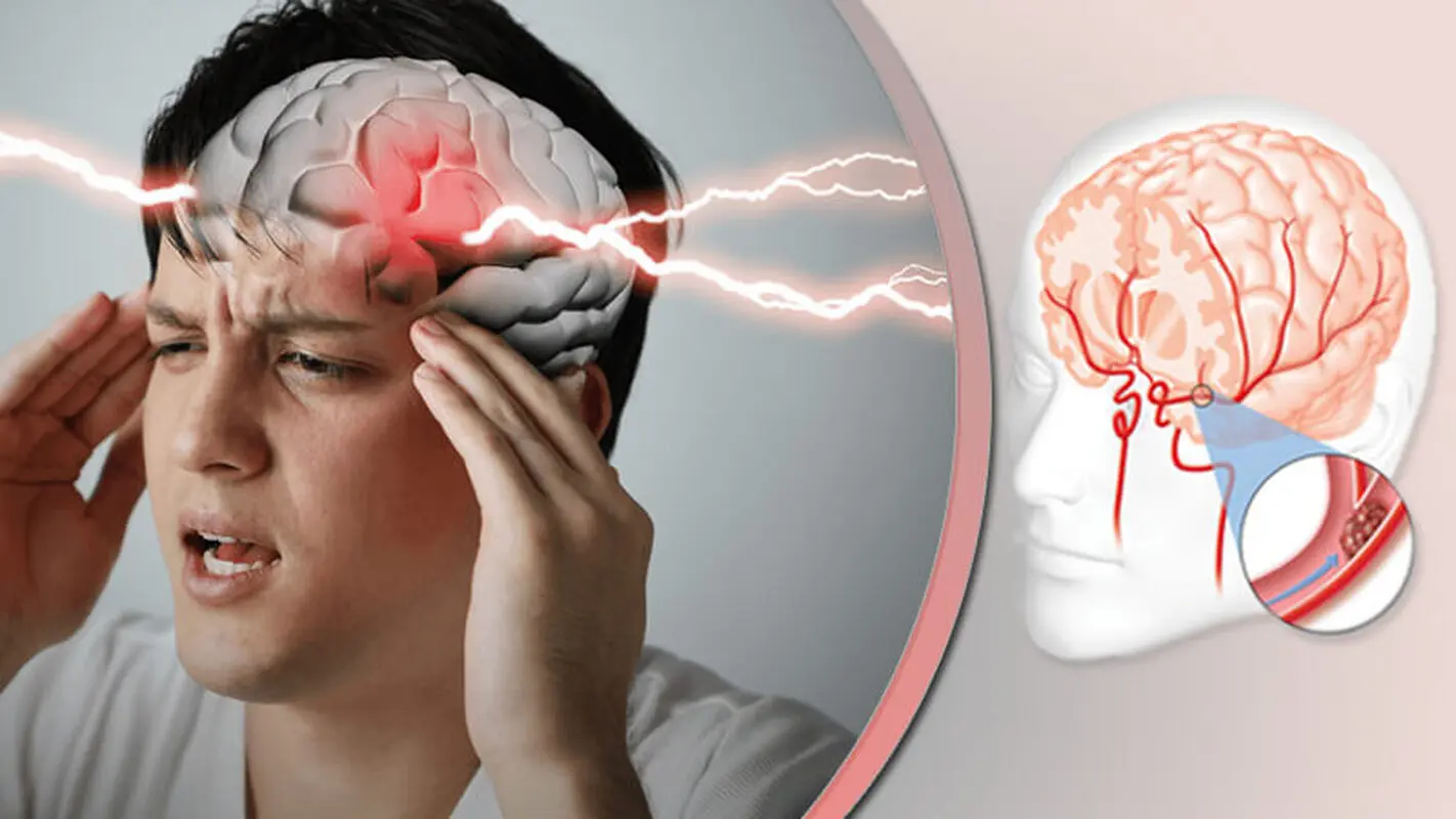اگر سردرد شدید دارید در معرض سکته مغزی هستید!