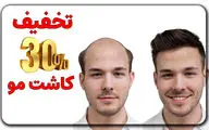 تخفیف ویژه کاشت مو | فرصتی استثنایی برای داشتن موهایی زیبا